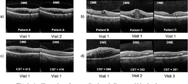 Figure 1 for Ophthalmic Biomarker Detection: Highlights from the IEEE Video and Image Processing Cup 2023 Student Competition