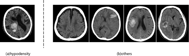 Figure 4 for Brain Hematoma Marker Recognition Using Multitask Learning: SwinTransformer and Swin-Unet