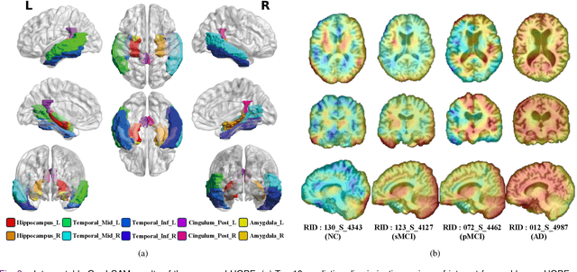 Figure 3 for HOPE: Hybrid-granularity Ordinal Prototype Learning for Progression Prediction of Mild Cognitive Impairment