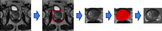 Figure 2 for Anomaly-Driven Approach for Enhanced Prostate Cancer Segmentation