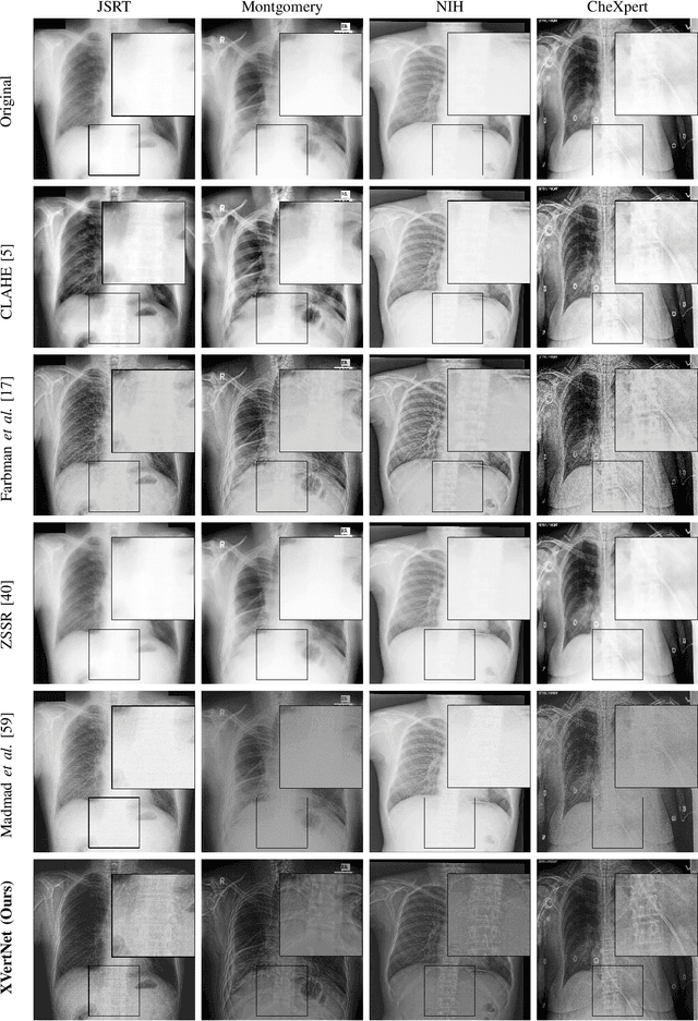 Figure 4 for Unsupervised Iterative U-Net with an Internal Guidance Layer for Vertebrae Contrast Enhancement in Chest X-Ray Images