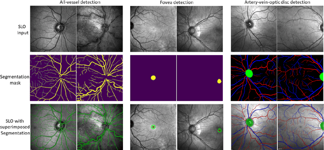 Figure 4 for SLOctolyzer: Fully automatic analysis toolkit for segmentation and feature extracting in scanning laser ophthalmoscopy images