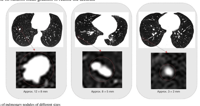 Figure 4 for Application of Computer Deep Learning Model in Diagnosis of Pulmonary Nodules