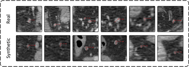 Figure 4 for LN-Gen: Rectal Lymph Nodes Generation via Anatomical Features