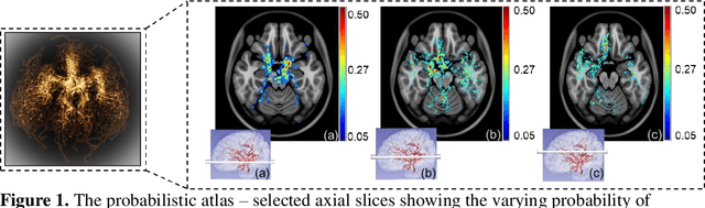 Figure 2 for Cerebrovascular morphology in aging and disease -- imaging biomarkers for ischemic stroke and Alzheimers disease