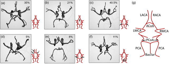Figure 3 for Cerebrovascular morphology in aging and disease -- imaging biomarkers for ischemic stroke and Alzheimers disease