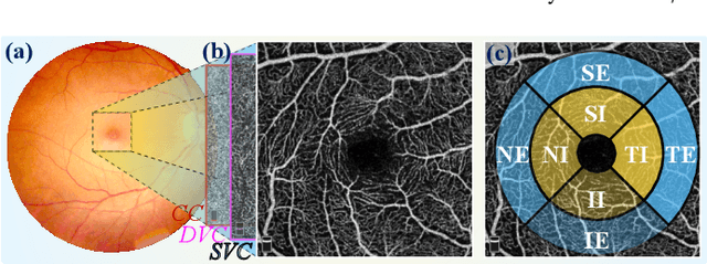 Figure 1 for Beyond the Eye: A Relational Model for Early Dementia Detection Using Retinal OCTA Images