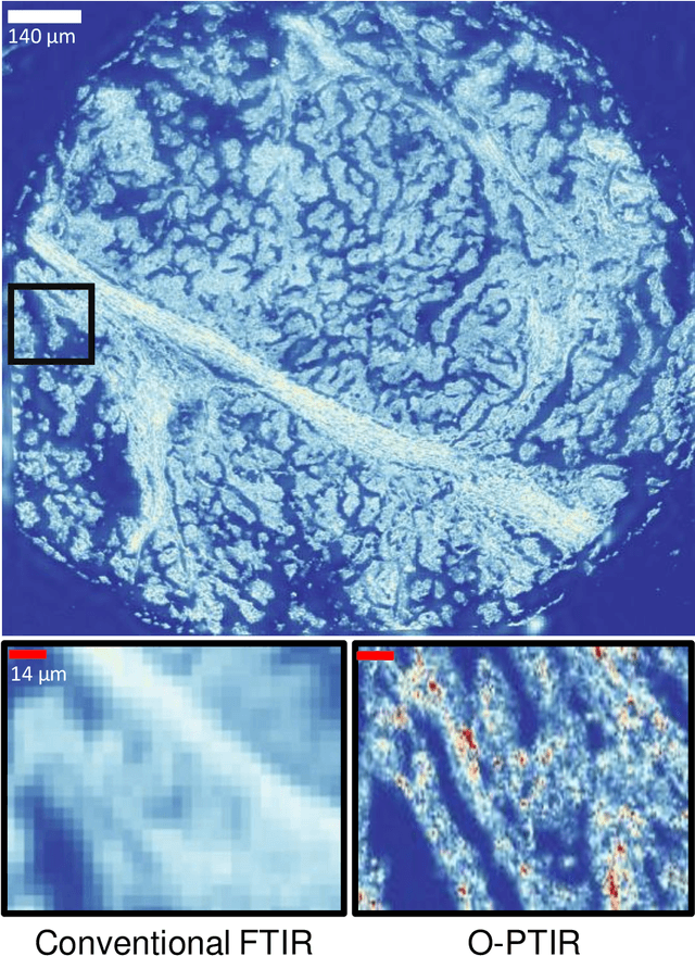 Figure 3 for Rapid hyperspectral photothermal mid-infrared spectroscopic imaging from sparse data for gynecologic cancer tissue subtyping