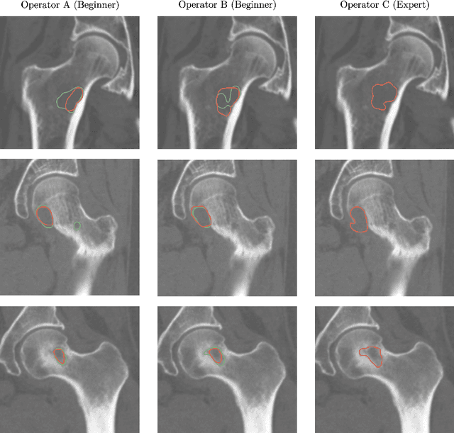 Figure 1 for Enhanced segmentation of femoral bone metastasis in CT scans of patients using synthetic data generation with 3D diffusion models