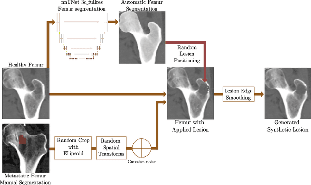 Figure 3 for Enhanced segmentation of femoral bone metastasis in CT scans of patients using synthetic data generation with 3D diffusion models