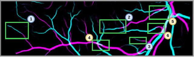 Figure 3 for RRWNet: Recursive Refinement Network for Effective Retinal Artery/Vein Segmentation and Classification