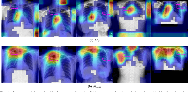 Figure 1 for Refining Tuberculosis Detection in CXR Imaging: Addressing Bias in Deep Neural Networks via Interpretability