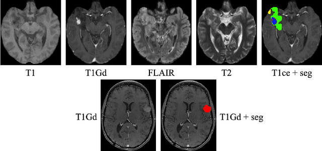 Figure 1 for Improved Multi-Task Brain Tumour Segmentation with Synthetic Data Augmentation