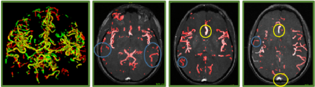 Figure 4 for VesselShot: Few-shot learning for cerebral blood vessel segmentation