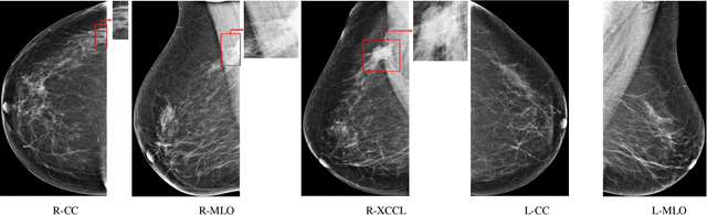 Figure 4 for Weakly Supervised Learning for Breast Cancer Prediction on Mammograms in Realistic Settings
