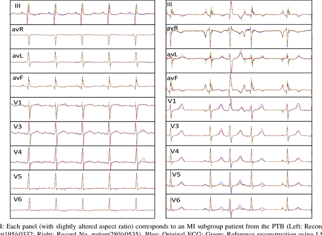 Figure 4 for AI-based 3-Lead to 12-Lead ECG Reconstruction: Towards Smartphone-based Public Healthcare
