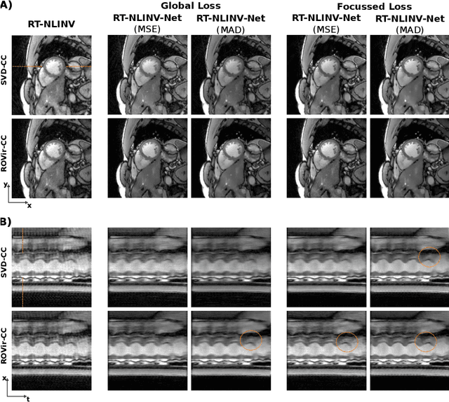 Figure 3 for Self Supervised Learning for Improved Calibrationless Radial MRI with NLINV-Net