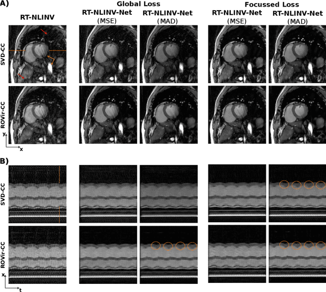 Figure 4 for Self Supervised Learning for Improved Calibrationless Radial MRI with NLINV-Net