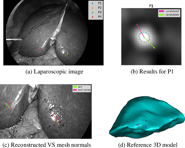 Figure 4 for Normal reconstruction from specularity in the endoscopic setting