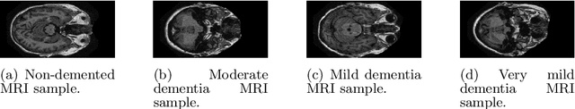 Figure 1 for Colormap-Enhanced Vision Transformers for MRI-Based Multiclass (4-Class) Alzheimer's Disease Classification