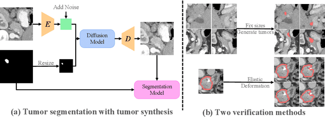 Figure 1 for Optimizing Synthetic Data for Enhanced Pancreatic Tumor Segmentation