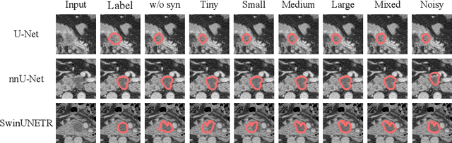 Figure 3 for Optimizing Synthetic Data for Enhanced Pancreatic Tumor Segmentation