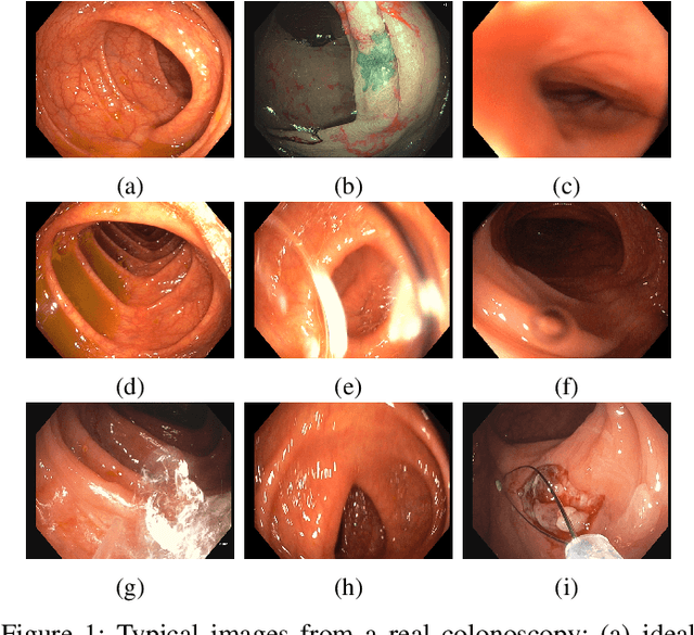 Figure 1 for CudaSIFT-SLAM: multiple-map visual SLAM for full procedure mapping in real human endoscopy