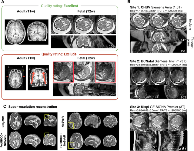 Figure 1 for FetMRQC: an open-source machine learning framework for multi-centric fetal brain MRI quality control