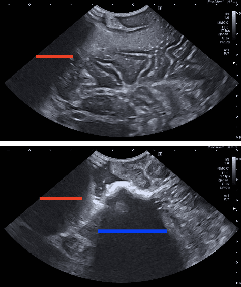 Figure 4 for Identifying Visible Tissue in Intraoperative Ultrasound Images during Brain Surgery: A Method and Application