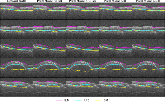 Figure 4 for Uncertainty-aware retinal layer segmentation in OCT through probabilistic signed distance functions