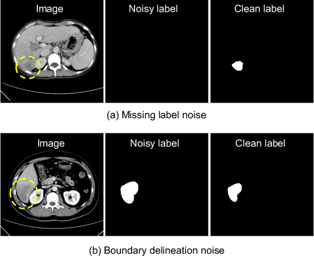 Figure 1 for Deep Self-cleansing for Medical Image Segmentation with Noisy Labels