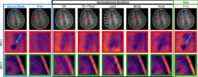 Figure 4 for Accelerating Longitudinal MRI using Prior Informed Latent Diffusion