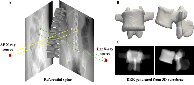 Figure 3 for EAR: Edge-Aware Reconstruction of 3-D vertebrae structures from bi-planar X-ray images