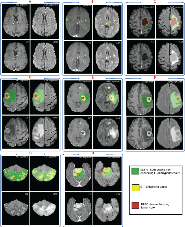 Figure 3 for The Brain Tumor Segmentation (BraTS-METS) Challenge 2023: Brain Metastasis Segmentation on Pre-treatment MRI