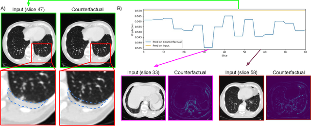 Figure 3 for Explaining 3D Computed Tomography Classifiers with Counterfactuals