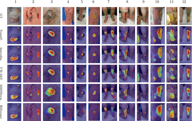 Figure 4 for WoundAmbit: Bridging State-of-the-Art Semantic Segmentation and Real-World Wound Care