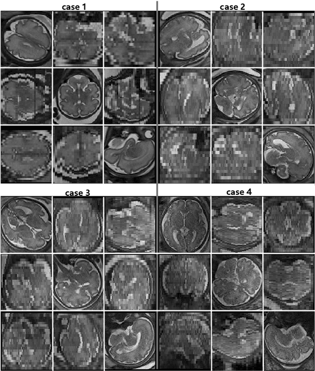 Figure 3 for Self-supervised Fetal MRI 3D Reconstruction Based on Radiation Diffusion Generation Model