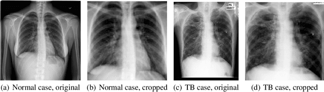 Figure 1 for Empowering Tuberculosis Screening with Explainable Self-Supervised Deep Neural Networks