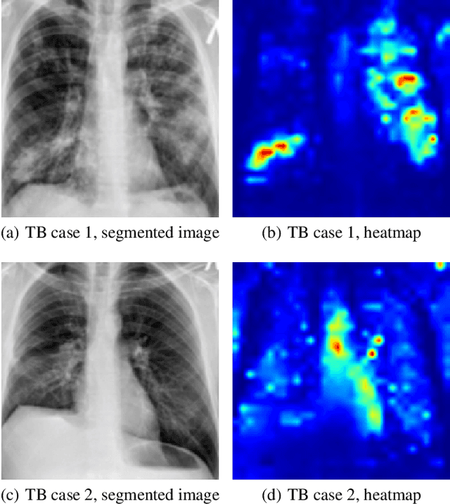 Figure 4 for Empowering Tuberculosis Screening with Explainable Self-Supervised Deep Neural Networks