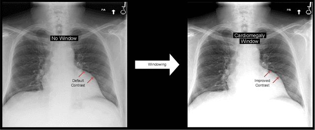 Figure 1 for WindowNet: Learnable Windows for Chest X-ray Classification