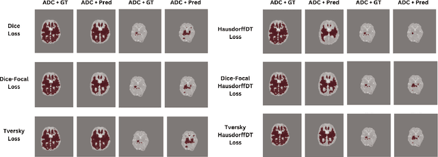 Figure 3 for Multimodal HIE Lesion Segmentation in Neonates: A Comparative Study of Loss Functions