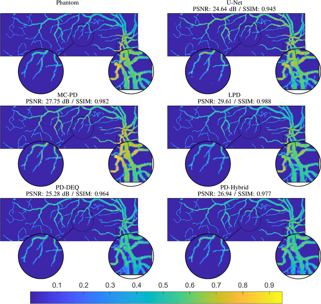 Figure 4 for Model-corrected learned primal-dual models for fast limited-view photoacoustic tomography