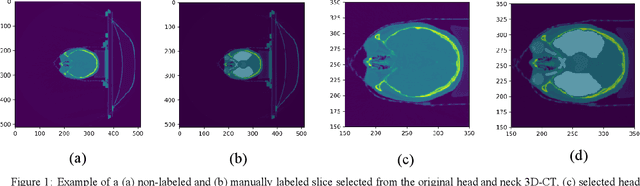 Figure 1 for Deep-learning Segmentation of Small Volumes in CT images for Radiotherapy Treatment Planning