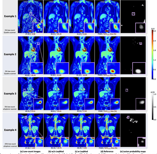 Figure 3 for LpQcM: Adaptable Lesion-Quantification-Consistent Modulation for Deep Learning Low-Count PET Image Denoising