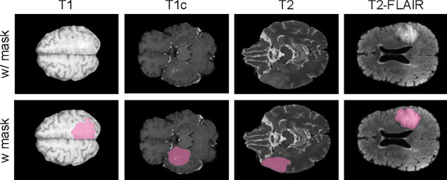 Figure 1 for GBT-SAM: A Parameter-Efficient Depth-Aware Model for Generalizable Brain tumour Segmentation on mp-MRI