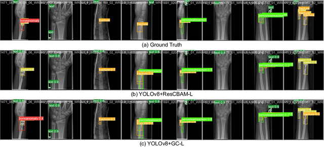 Figure 4 for Global Context Modeling in YOLOv8 for Pediatric Wrist Fracture Detection