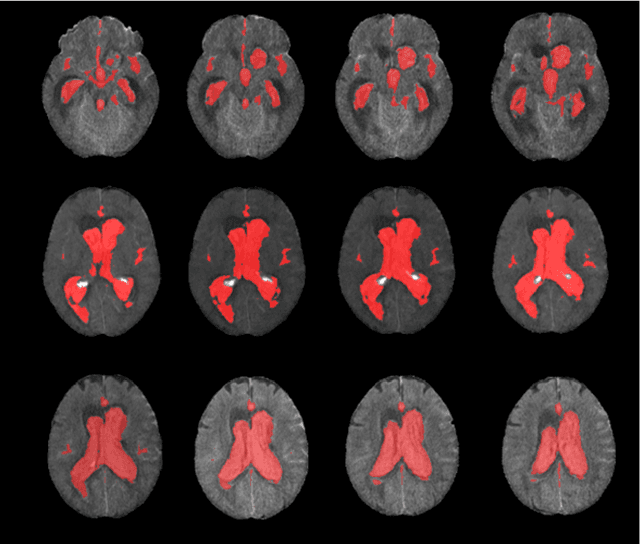 Figure 2 for A Fully Automated Pipeline Using Swin Transformers for Deep Learning-Based Blood Segmentation on Head CT Scans After Aneurysmal Subarachnoid Hemorrhage
