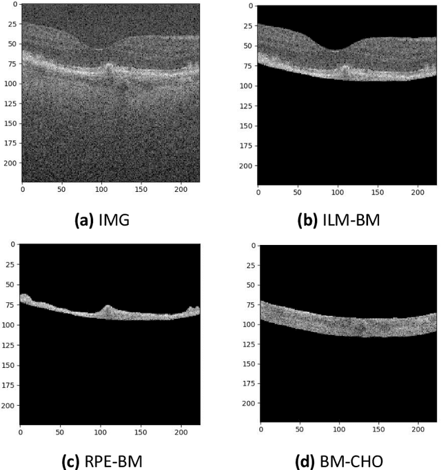 Figure 3 for Comparison of different retinal regions-of-interest imaged by OCT for the classification of intermediate AMD