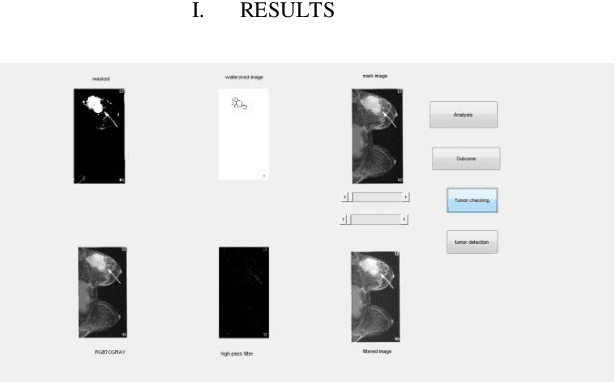 Figure 1 for Development of an interactive GUI using MATLAB for the detection of type and stage of Breast Tumor