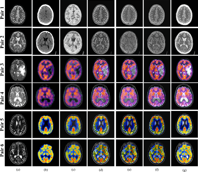 Figure 4 for Multi-modal Medical Neurological Image Fusion using Wavelet Pooled Edge Preserving Autoencoder